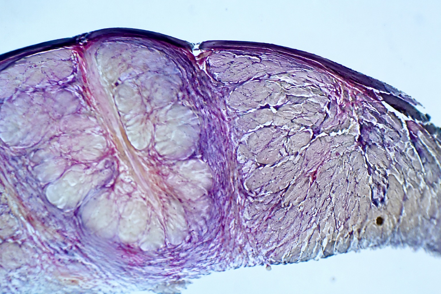 Cross-section comparison of normal skin sebaceous glands versus shrunken glands caused by isotretinoin Accutane dryness